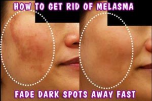 How to Get Rid of Melasma