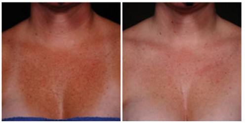 ELASTIderm Decolletage Before and After