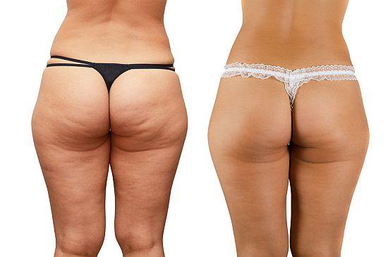 Cellulaze Before and After Buttocks