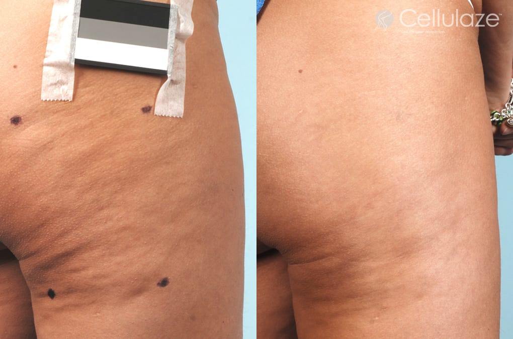 Cellulaze Before and After