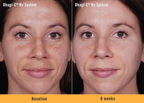 Obagi-C Rx System Before and After