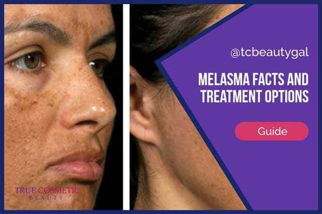 Melasma Facts and Treatment Options Guide